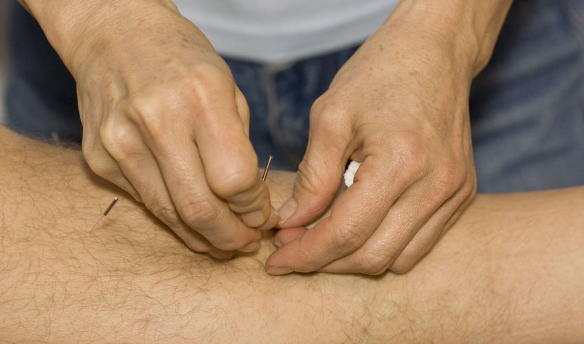 Cropped image of hand applying acupuncture needle on skin