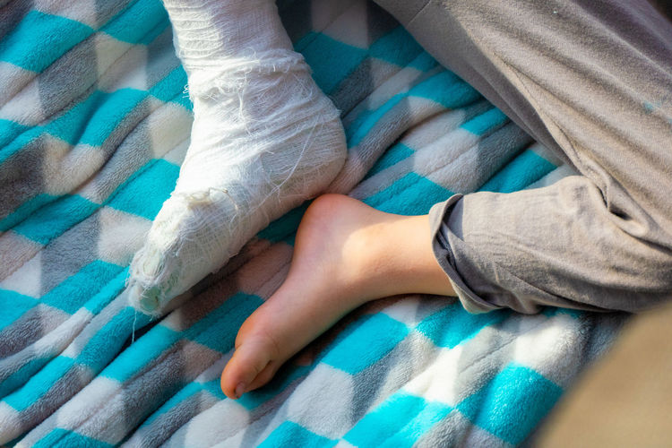 Child with bandage on leg heel fracture. broken right foot, splint of toddler. 
