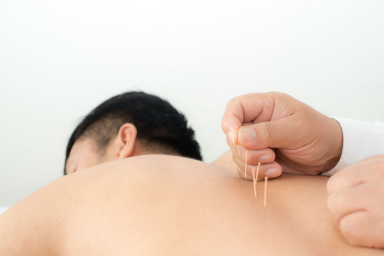 Midsection of man receiving acupuncture therapy