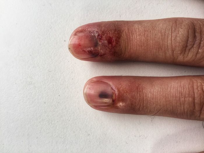 Cropped injured fingers on table
