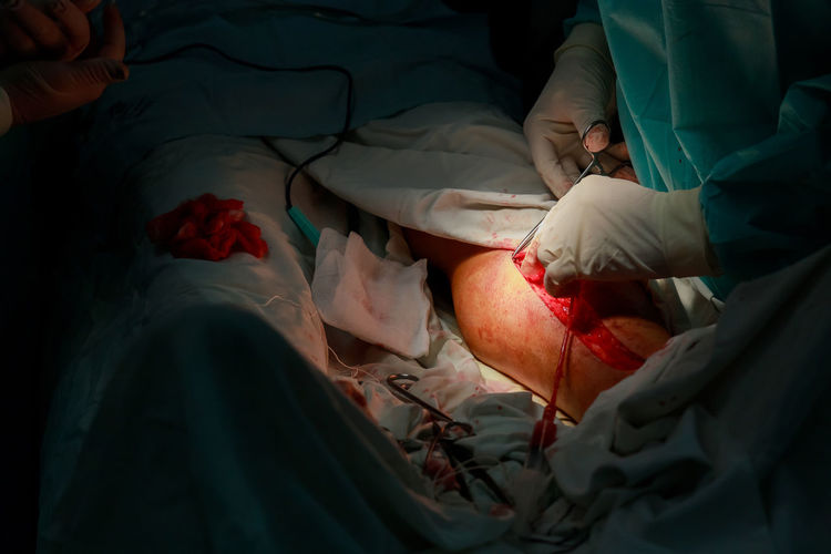 Midsection of surgeons stitching patient leg in hospital