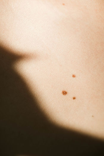 Closeup view shot of skin with birthmarks