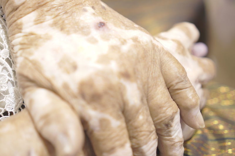 Close-up of human hand suffering from vitiligo