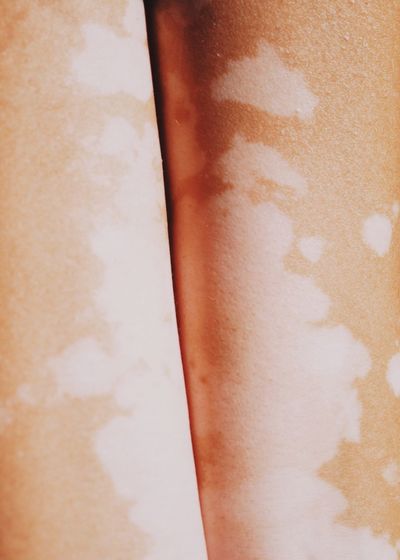 There is uniqueness in everyone. In everything we have. Body and soul Vitiligo Human Skin Human