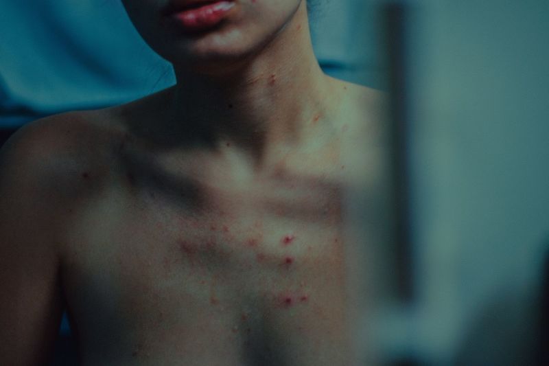 Midsection of shirtless woman with chickenpox on chest