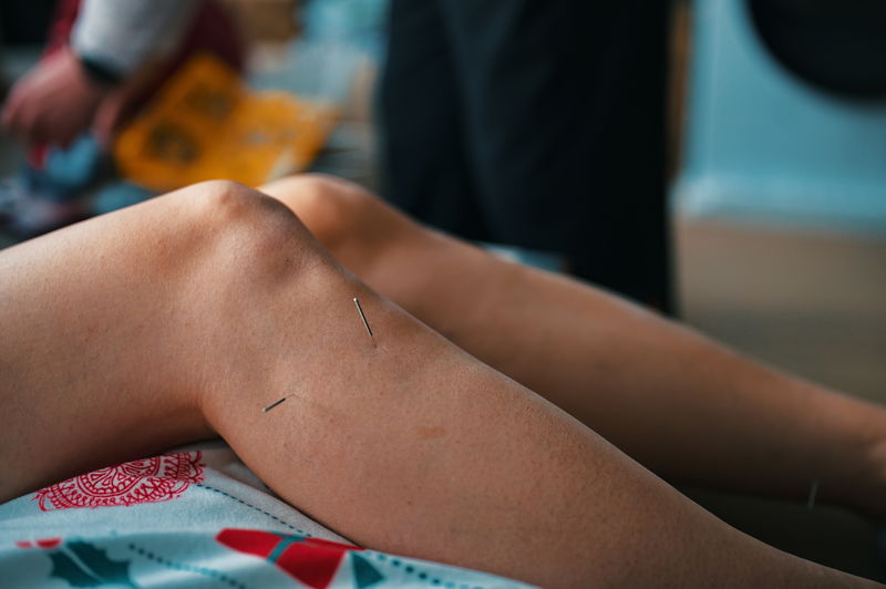 Therapy of female leg with acupuncture needles