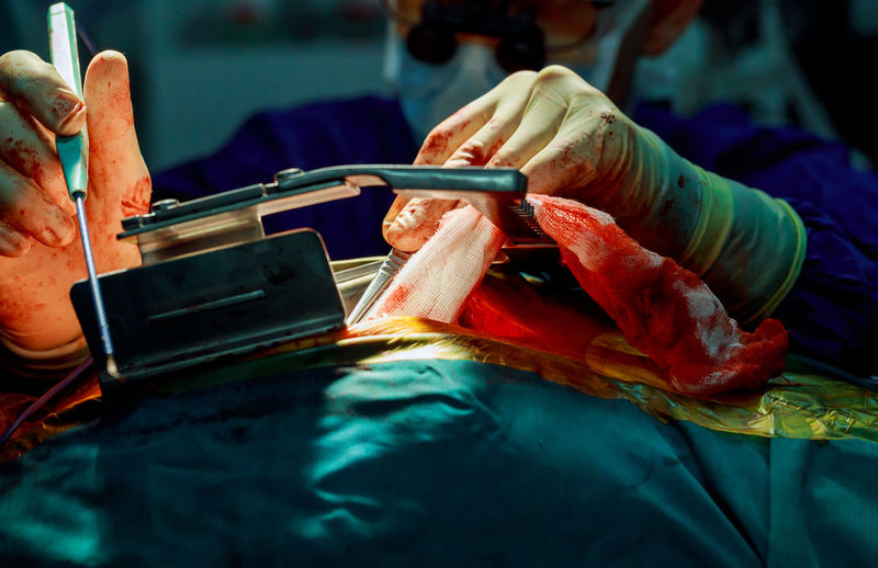 Cropped image of surgeon operating patient