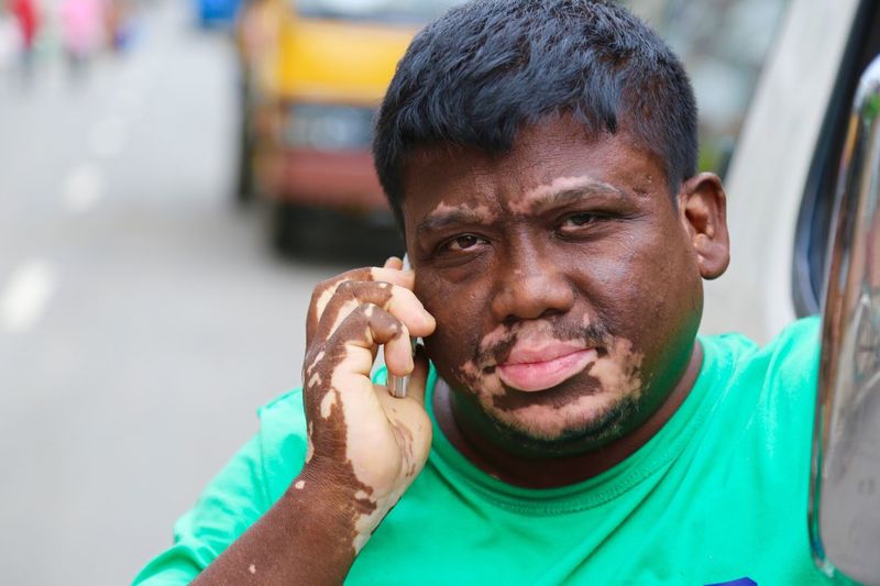 Portrait of man suffering from vitiligo talking on mobile phone on street