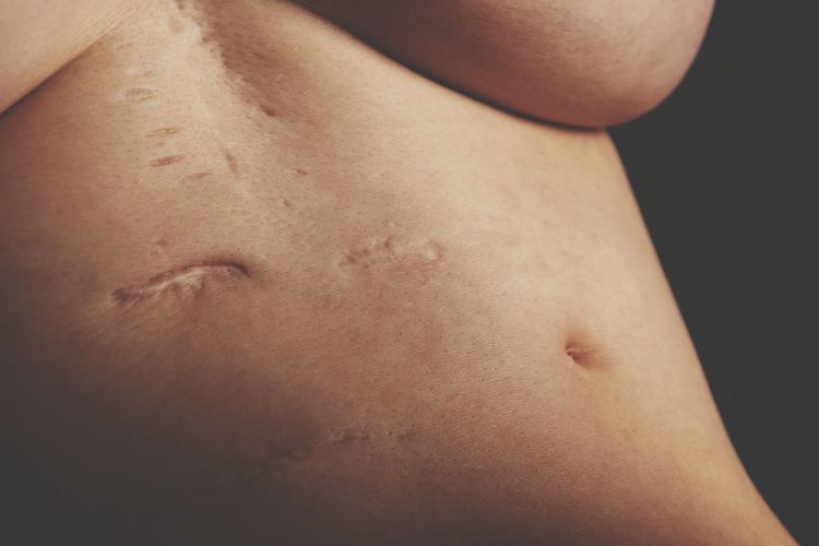 Close-up of medical stitches on woman abdomen